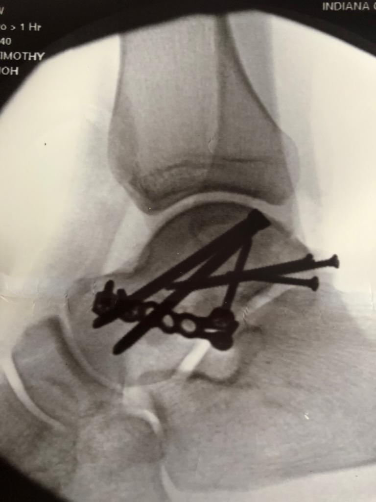 An X-ray of Mathew Scholtz's right ankle post-surgery. Photo courtesy Mathew Scholtz and Westby Racing.