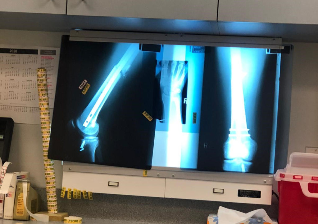 Bradley Ward's post-surgery X-rays. Photo courtesy Bradley Ward Racing.