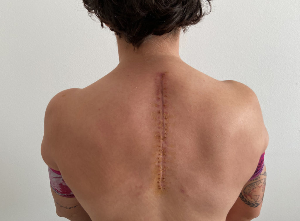 Ana Carrasco's back, prior to her recent surgery. Photo courtesy Kawasaki.