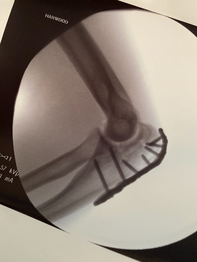 Kyle Wyman's left elbow post-surgery. Photo courtesy Kyle Wyman Racing.