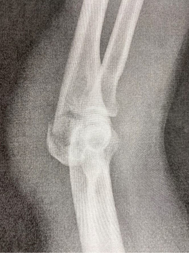 An X-ray of Kyle Wyman's left elbow prior to surgery. Image courtesy Kyle Wyman Racing.