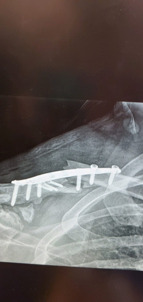 Screws pulled out of Jeremy Cook's surgically repaired collarbone, seen here in an X-Ray.