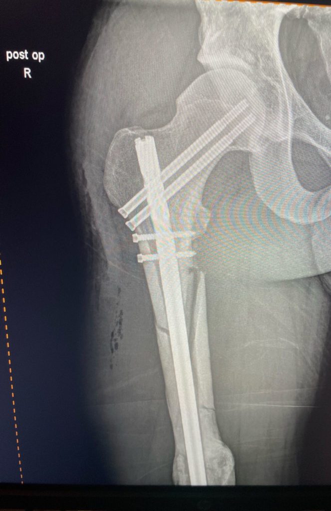 The upper part of Bradley Ward's broken right femur. Image courtesy Bradley Ward Racing.