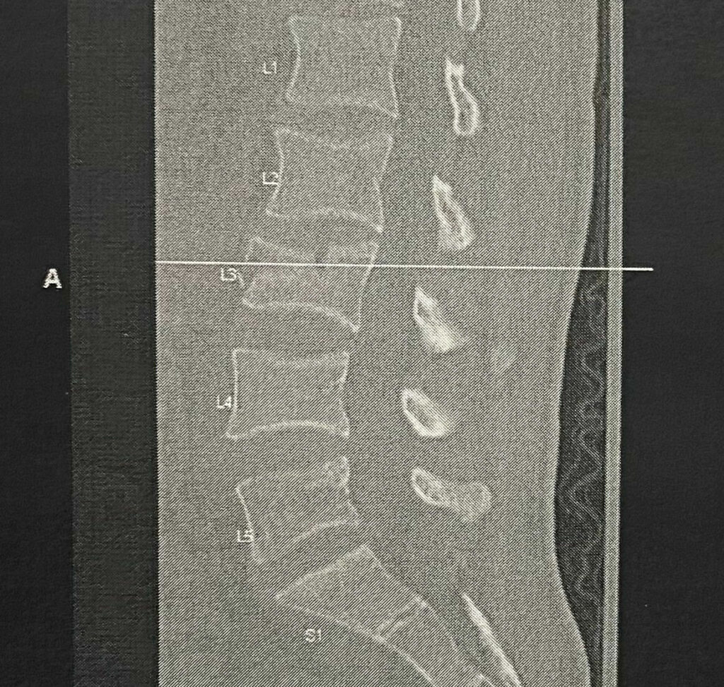 A scan of Brandon Paasch's spine clearly shows the fracture in his L3 vertebra. Image courtesy Brandon Paasch.