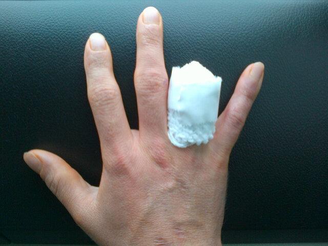 More On Hopkins' Finger Amputation